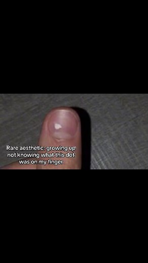 Understanding the Rare Aesthetic of White Dots on Fingernails