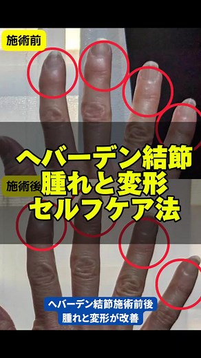 ヘバーデン結節の腫れと変形をセルフケア！ #整骨院 #整体 #健康 #腱鞘炎 #更年期