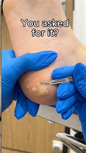 You Asked For It! 👣 What Causes Verrucas & How We Treat Them #plantarwart #warts