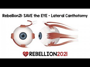 Rebellion21: SAVE the EYE – Lateral Canthotomy via Andy Little, DO