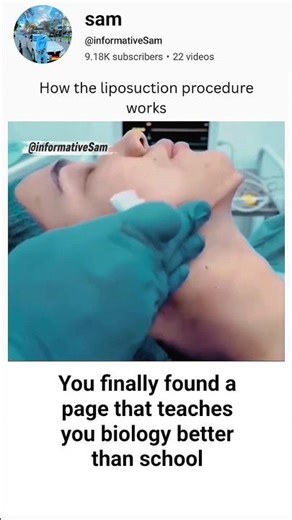 How liposuction procedure works #brainlearning #biologyscience #medicaleducation
