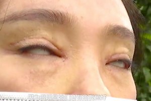 Botched double eyelid surgery leaves woman unable to shut her eyes