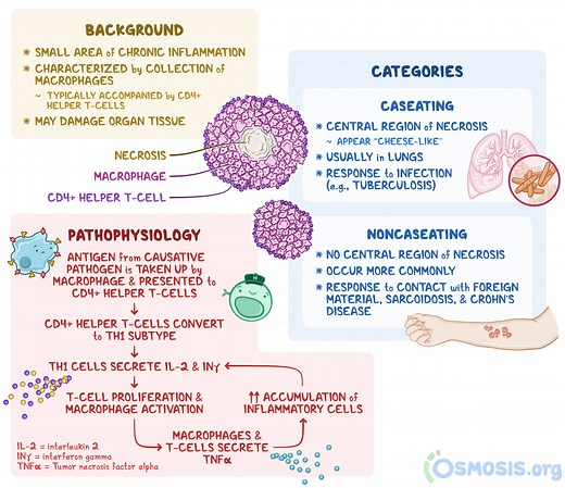Granulomas: What Is It, Types, Causes, and More | Osmosis