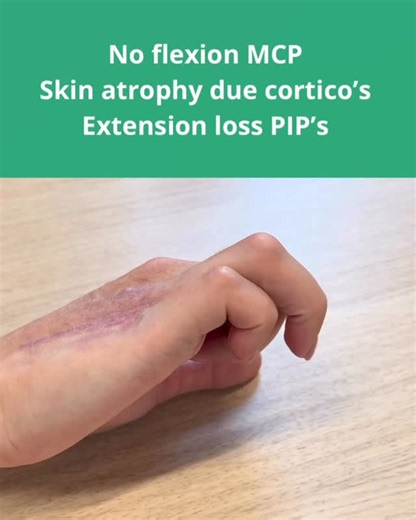 dr. Xander Smit - Hand Surgeon / Handchirurg on Instagram: "•• Following plate fixation of a metacarpal fracture, this young patient had already undergone two attempts at tenolysis and plate removal elsewhere. She presented with no active or passive flexion of MCP IV–V ❌✋ 🔍 Key point: Dorsal tenolysis for MCP flexion should be performed under WALANT and must include a dorsal MCP capsulolysis. 🛠️ My stepwise approach: • First, release the interval between the EDC and the MCP capsule • Then perf