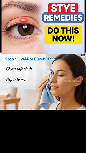 Get rid of your stye faster #eyecareoptom