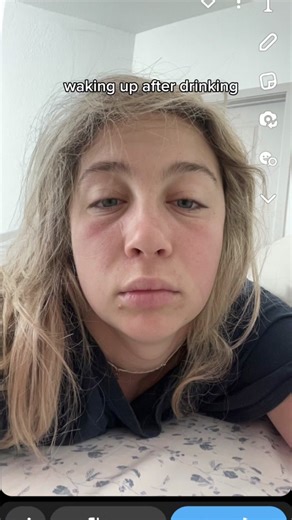 Alcohol Effects on Facial Swelling: Before and After Transformation