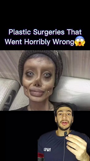 Plastic Surgeries Gone Wrong: Shocking Transformations