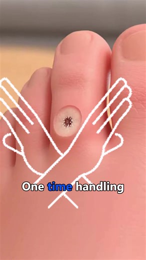 What you see change first isn’t always the final result #verrugas #warts #skin #skincare #animation