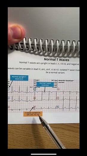 What can cause T wave inversions 🤔