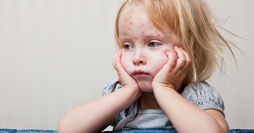 Can your kid still get the chicken pox if they’ve had the shot? - Today's Parent
