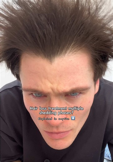 Shedding again on hair loss treatment explained ⬇️ DISCLAIMER ⚠️: This content is for educational purposes only and is not medical advice. Prescription-only medications require consultation with a medical professional. So when using finasteride or dutasteride, perhaps alongside minoxidil, you tend to go through an initial shedding phase in which current hairs fall out. This is a good sign, as it means miniaturised hairs in the resting phase have fallen to make way for new healthy ones that will 