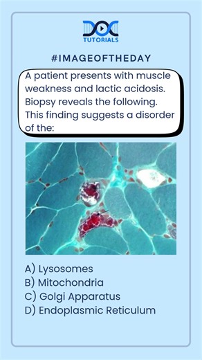 Muscle Weakness & Lactic Acidosis: Diagnose the Disorder | NEET PG Image of the Day
