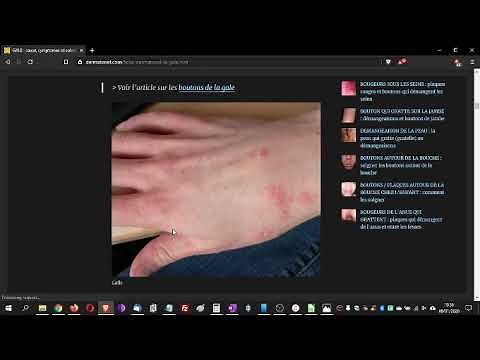 GALE : la gale, qu'est-ce que c'est, conseils de dermatologue