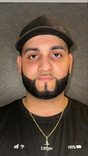 Dariel’s NEW stunning Emerald Green eyes. 🌿💚 Keratopigmentation procedure. 👁️