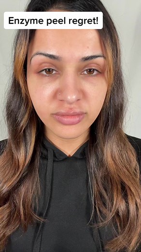 My experience of a professional enzyme peel, gone wrong! . . #sensitiveskin #enzymepeel #skincare #dryskin #facial #facialtreatment #skintreatment #enzymetherapy #facials #badexperience #donotrecommend #beauty