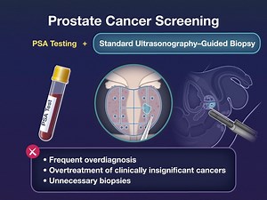 MRI with targeted biopsy might improve diagnostic accuracy in prostate cancer screening. New research findings are summarized. https://nej.md/3y879lT | The New England Journal of Medicine
