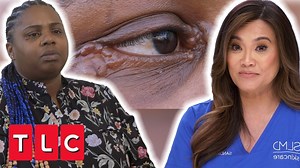 26K views · 180 reactions | Dr. Lee’s new patient has a case of hidrocystomas in her eyes. Dr. Lee tells her it is going to be a hard removal. Dr. Lee has to whip out all her skills to help her. #pimple #popper #drpimlepopper #drsandralee | Pimple Daily Post | Facebook