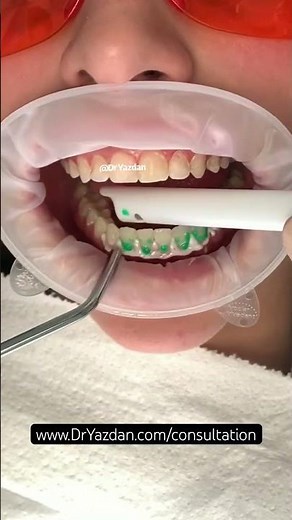 Icon resin infiltration | Dr. Yazdan | white spots on teeth | icon dental treatment