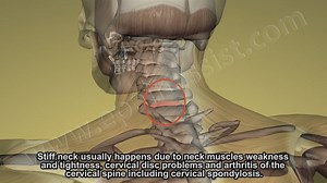 6.1K views · 46 reactions | Neck Stiffness or Stiff Neck is quite a...