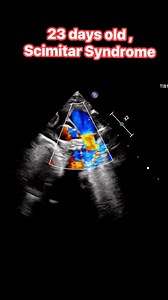 23-day-old, Scimitar Syndrome . | Cardiophilia