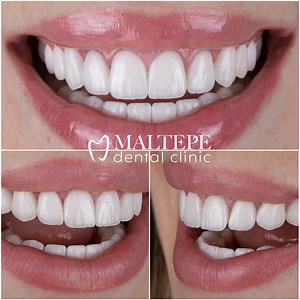 Perfect Teeth: What Can You Do To Have? - Maltepe Dental Clinic
