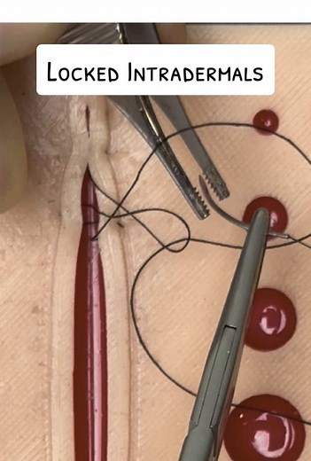 Running Locked Intradermal Sutures Practice Techniques
