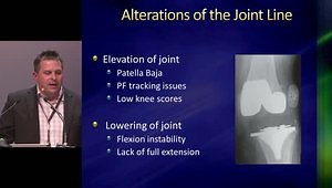 Gap Balancing and the Joint Line in a Total Knee Replacement