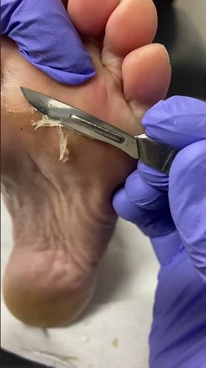 Watch as an expert Aussie podiatrist tackles forefoot callus removal! #Podiatry