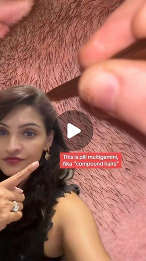 Suchismita (Tia) Paul, MD Dermatologist on Instagram: "This is pili multigemini - multiple hairs within a single follicle that’s most common in the beard. Plucking them can be satisfying but treatment is usually laser hair removal or electrolysis. #pilimultigemini #learnoninstagram #weird #beard #hair"