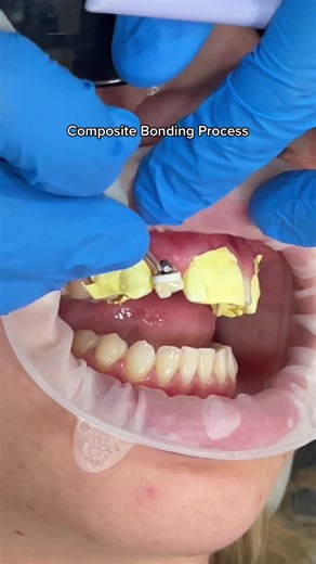 Composite Bonding Process for Resizing Small Teeth