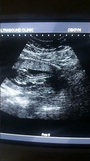 normal nuchal translucency at 23 weeks #ultrasound