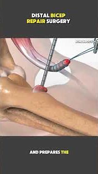 Distal Bicep Repair Surgery | Step-by-Step Procedure Explained #orthopedicsurgery
