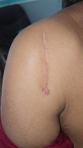 Post Operative Status Humerus Head #fracture #fracturemanagement #Fracture