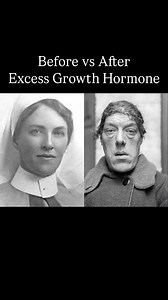 Mary Ann Bevan (1874 - 1933) was an English woman who toured the sideshow circuit as “the ugliest woman in the world” after her appearance drastically changed due to developing acromegaly. It leads to excess growth hormone which causes enlargement of the forehead, jaw, and nose. In the early 2000s, Bevan’s image was used by Hallmark Cards on a birthday card in the United Kingdom. The card made reference to the television dating show Blind Date. Subsequently, a complaint was made by a Dutch physi