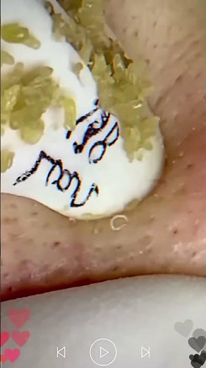 Most Satisfying Blackhead Removal Ever! Real Pore Deep Clean #skincare #blackheadremoval 9