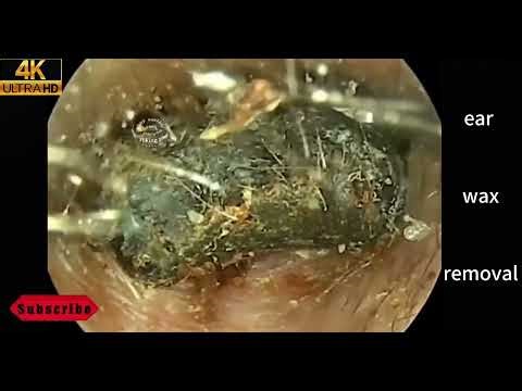 Ear Wax Removal & Ear Cleaning | Relaxing Ear Cleaning Wax Removal ASMR