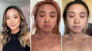 Aussie living with eczema details her life with topical steroid withdrawal