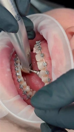 Dr Chandra Mohan | Invisalign | Hyderabad🇮🇳 on Instagram: "Fixed Retainers 🦷✨ A fixed retainer is a thin wire 🪡 that’s glued behind your front teeth (usually the lower ones) 😬➡️ to keep them straight after your braces come off 🎉! It’s invisible from the front 👀❌ and works all the time ⏰—you don’t have to remember to put it in or take it out 🙌. You’ll still need to brush carefully 🪥 and use floss threaders 🧵 to clean 