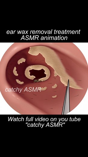 Ear wax removal treatment animation|| ASMR animation|| #asmr #asmrsounds #stopmotionanimation #2danimation #trending #trend #relaxingasmr #shortfilmanimation #asmranimationstory #shortfilm #animation2d #earwaxremoval #earrings #ears #treatmentanimation #catchyasmr #asmranimation
