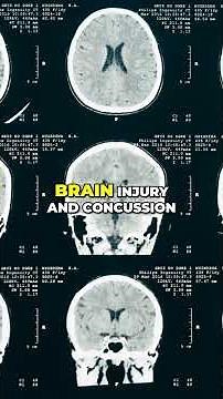 Concussion Diagnosis What You NEED To Know | Peak Brain and Body | Tampa FL