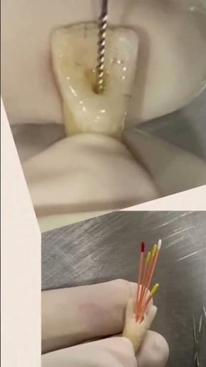 Complete RCT Procedure from beginning to the end