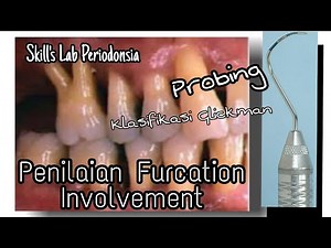 Penilaian Furcation Involvement---Probing dengan Probe Nabers [SKILL'S LAB FKG 04]