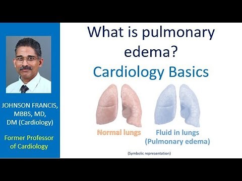 What is pulmonary edema? Cardiology Basics