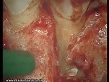 Complicated Tooth Root Fracture • Video • MEDtube.net