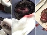 Gruesome moment Dr Pimple Popper removes egg-sized cyst on woman's head