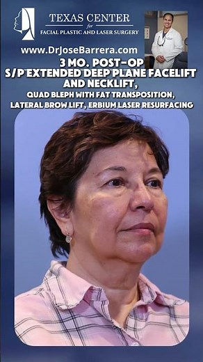 3 months post-op following an Extended Deep Plane Facelift & Neck Lift, Quad Blepharoplasty