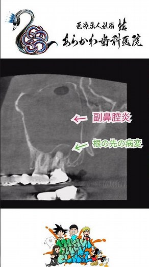 歯が原因で副鼻腔炎に！?…なります！早く治療しましょう！ #あらかわ歯科医院
