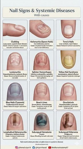 Nail Signs & Systemic Diseases | Clinical Nail Examination Explained