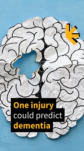 Falls are the most common way adults over 65 are injured. Research published in 2024 suggests they could also predict a decline in cognitive health in the not-too-distant future. Read more: https://www.sciencealert.com/shockingly-common-injury-linked-with-increased-dementia-risk #dementia #falls #science | ScienceAlert