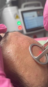 2.5K views · 11 reactions | We offers CO2 Fractional Laser treatment for skin rejuvenation, Acne scars and skin resurfacing. The procedure uses fractional CO2 lasers stimulating collagen production and skin regeneration. Customizable intensity makes it suitable for various skin types. Quick recovery times and effective results make it a promising option for those seeking skin improvement. | Ritchel Pulido - Bastasa | Facebook